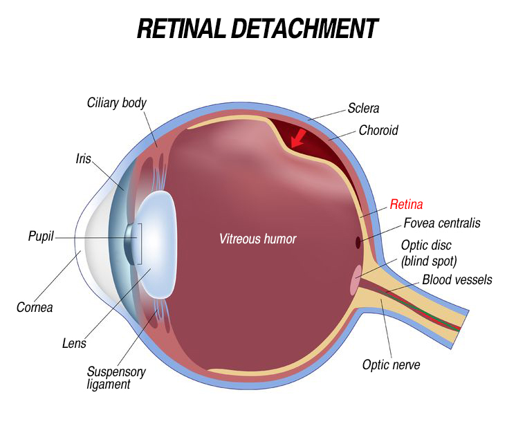 retina detachment